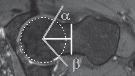 Section of femoral head neck to show alpha and beta angle