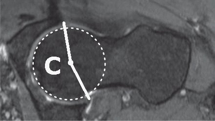 Global loss of acetabular range of motion