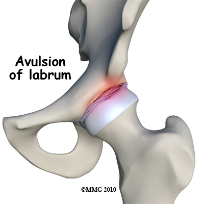 Avulsion of the labrum